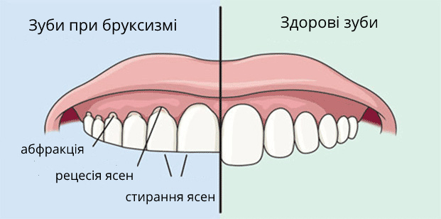 бруксизм
